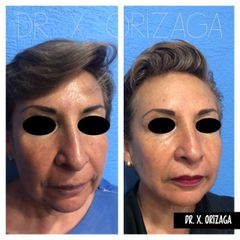 Antes y depués de Rejuvenecimiento facial - Skin Medical System