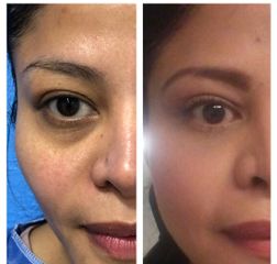 Antes y después de Eliminación de ojeras - Skin Medical System