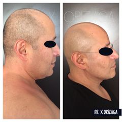 Antes y depués de Cirugía de papada - Skin Medical System