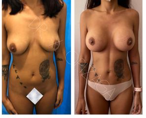 Antes y depués de Aumento de busto + Liposucción - Skin Medical System
