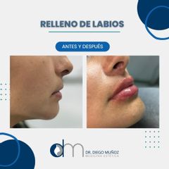 Aumento de labios - Dr. Diego Muñoz