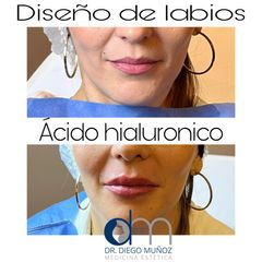 Aumento de labios - Dr. Diego Muñoz