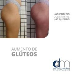 Gluteoplastia - Dr. Diego Muñoz