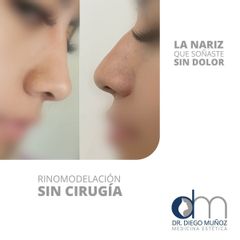Rinomodelación  - Dr. Diego Muñoz