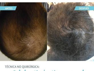Alopecia antes y después - 877122