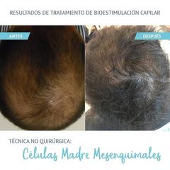 Alopecia - Derma Aesthetics PDC