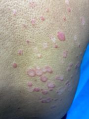 Eliminación de Verrugas - Derma Aesthetics PDC