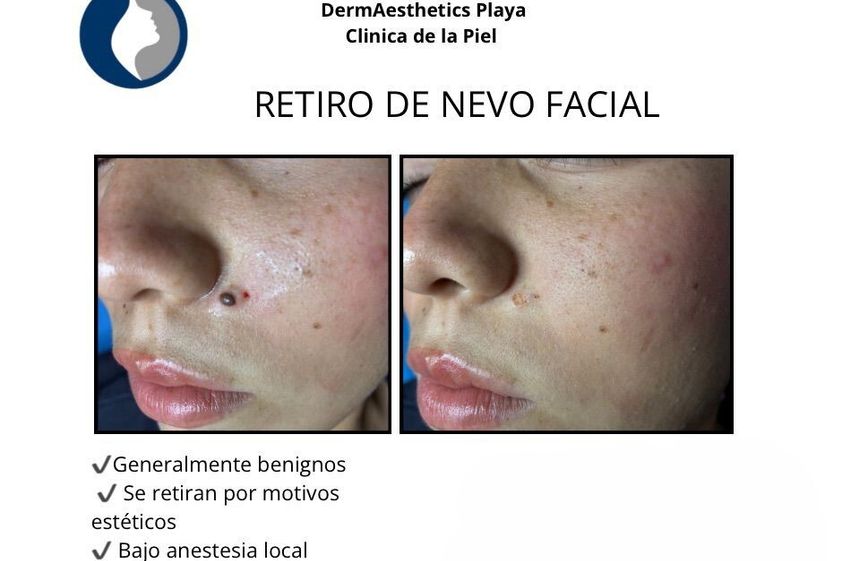 Eliminación de lunares antes y después - 877127