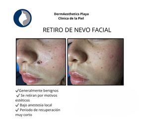 Eliminación de Lunares  - Derma Aesthetics PDC