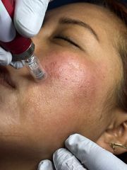 Tratamientos Faciales - Derma Aesthetics PDC
