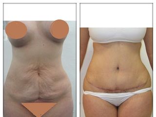 Antes y después de Abdominoplastia