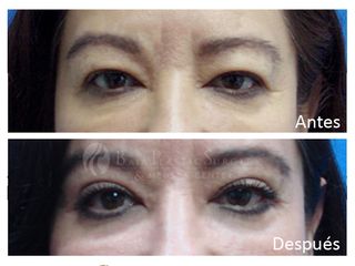 Antes y después de blefaroplastia