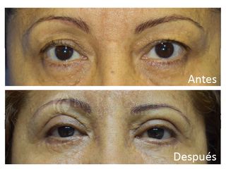 Antes y después de blefaroplastia