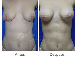 Antes y después de Liposucción en torso con lipoinyección en busto