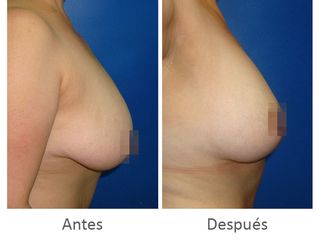 Antes y después de Pexia