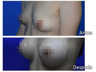 Antes y después de implantes mamarios 