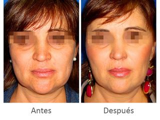 Antes y después de armonía facial: Hilos tensores + Bioplastia