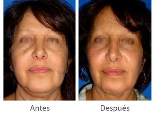 Antes y después de Lipo láser de papada y mejillas