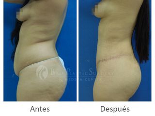 Antes y después de Abdominoplastia