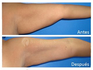 Antes y después de Lipo láser de brazos