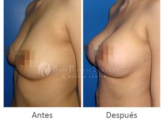 Antes y después de Implantes mama