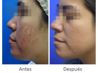 Antes y después de Resultados de tratamiento blue light para acné