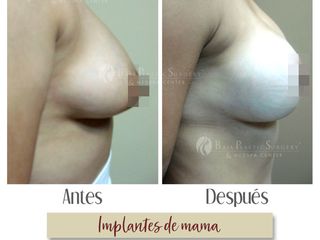 Antes y después de Aumento de busto