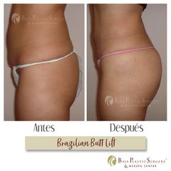 Antes y después de brazilian butt lift