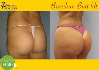 Antes y después de Gluteoplastia 