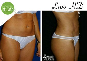 Antes y después de Lipoescultura HD  