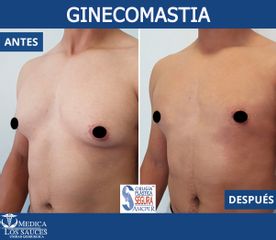 Antes y después de  Ginecomastia