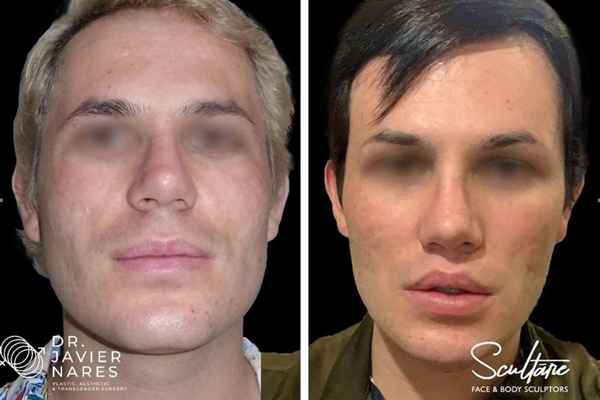 Reasignación de sexo antes y después - 663954