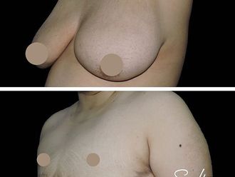 Reasignación de sexo antes y después - 663997