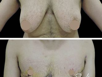 Reasignación de sexo antes y después - 664006