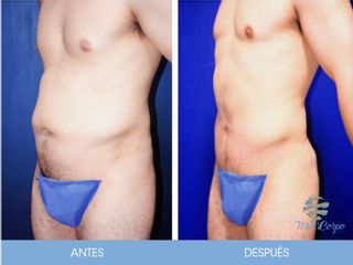 Antes y después de Lipoescultura