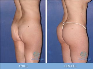 Antes y después de Lipoinyección glútea