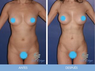 Antes y después de Lipoescultura y aumento mamario