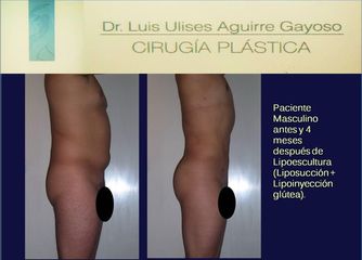 Antes y después Lipoescultura