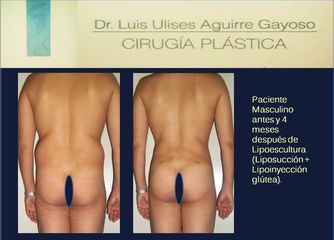 Antes y después Lipoescultura