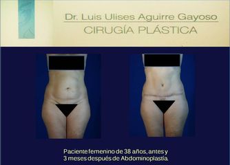 Antes y después Abdominoplastia