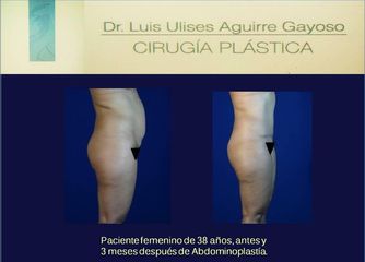 Antes y después Abdominoplastia