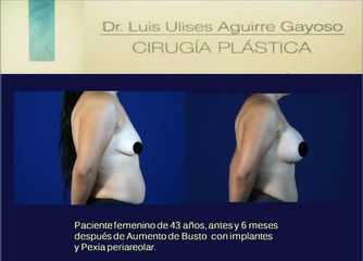 Antes y después Aumento de busto