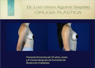 Antes y después Aumento de busto