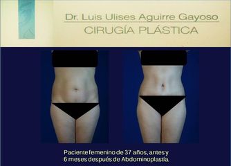 Antes y después Abdominoplastia