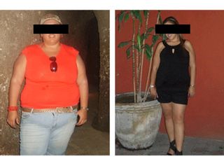 Antes y depués de Cirugía de la obesidad