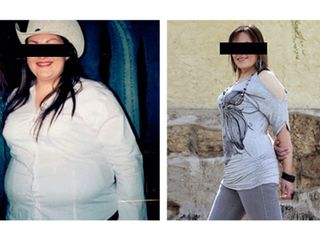 Antes y depués de Cirugía de la obesidad