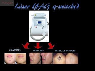 Antes y después de Laser YAG