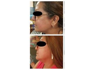 Antes y después de Tratamientos faciales