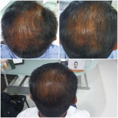Antes y después de Alopecia