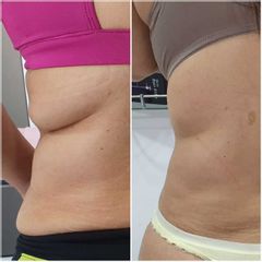 Hidrolipoclasia